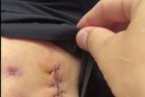 Hàng chục ổ áp xe hoại tử vì tiêm tan mỡ để thon gọn