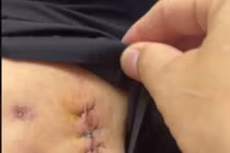 Hàng chục ổ áp xe hoại tử vì tiêm tan mỡ để thon gọn