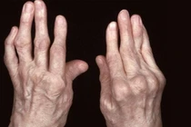 Nhận biết viêm khớp dạng thấp sớm để tránh tàn phế