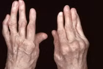 Nhận biết viêm khớp dạng thấp sớm để tránh tàn phế