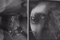 Hình ảnh thực quản trong nội soi dạ dày (bên phải) và lỗ thủng thực quản phát hiện khi phẫu thuật vùng bụng.