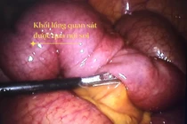 Tắc ruột do lồng ruột vì u