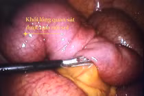 Tắc ruột do lồng ruột vì u