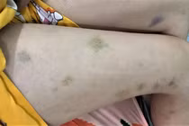 Vết thâm tím bất thường trên da cảnh báo bệnh gì?