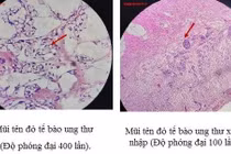 Mổ viêm ruột thừa xét nghiệm hóa ung thư