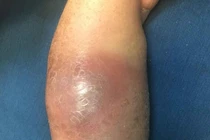 Đắp lá thầy lang chữa gãy tay dính ngay nhiễm khuẩn huyết