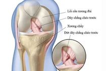 Nên điều trị khớp thoái hóa hay dây chằng mất chức năng?