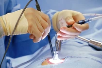 Các phương pháp phẫu thuật điều trị trào ngược dạ dày