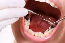 Sợ nhổ răng dẫn đến sâu răng