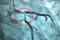 Nhồi máu cơ tim cấp do bệnh lý đa hồng cầu