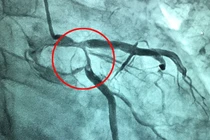 Nhồi máu cơ tim cấp do bệnh lý đa hồng cầu