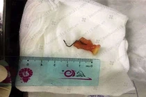 Tưởng ung thư hóa răng giả rơi vào thực quản