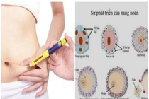 Nguy cơ khi kích trứng để sinh đôi