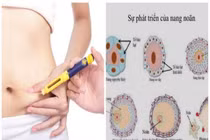 Nguy cơ khi kích trứng để sinh đôi