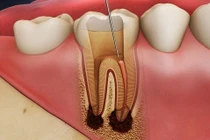 Biến chứng khủng khiếp chỉ từ viêm tủy răng 