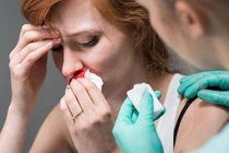 Chảy máu cam khi uống thuốc đối kháng vitamin K