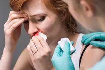 Chảy máu cam khi uống thuốc đối kháng vitamin K