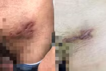 Quan hệ đồng tính không an toàn, nhiễm bệnh hiếm gặp