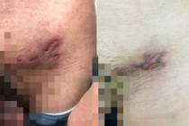 Quan hệ đồng tính không an toàn, nhiễm bệnh hiếm gặp