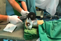 Cả cánh tay bị cuốn vào máy xay thịt 