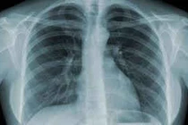 Cảnh giác với vết mờ trên phổi