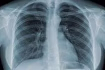 Cảnh giác với vết mờ trên phổi