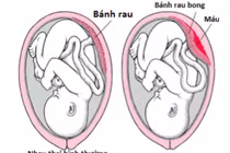 Sản phụ sức khỏe tốt vẫn bị rau bong non