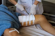 Bình rượu 20 lít phát nổ, người đàn ông bị đứt cơ chân