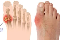 Bài thuốc hay phòng trị bệnh gút 