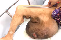 Bệnh viện Chợ Rẫy khám sàng lọc cho bệnh nhân bị u sợi thần kinh