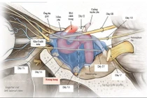 Đã cứu sống được u máu trong xoang tĩnh mạch hang