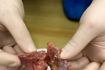 Y học Việt lần đầu ra tay triệt căn u cột sống