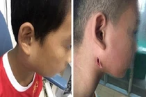 Trẻ 9 tuổi bị vi khuẩn ăn thịt người tấn công