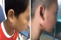 Trẻ 9 tuổi bị vi khuẩn ăn thịt người tấn công