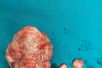  Quá nhiều nhân xơ vì để lâu không điều trị