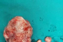  Quá nhiều nhân xơ vì để lâu không điều trị