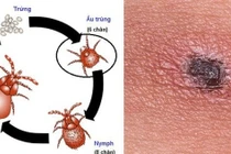 Sốc nhiễm khuẩn, suy đa tạng do sốt mò