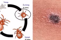 Sốc nhiễm khuẩn, suy đa tạng do sốt mò