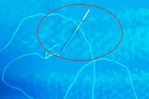 Kinh hãi cảnh bé 12 tuổi nuốt kim khâu, sợi cước dài 30cm vào bụng