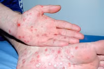 Tình dục không an toàn, nam bệnh nhân nổi ban vùng thân