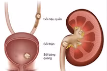 Sạch sỏi chớ nên chủ quan