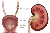 Sạch sỏi chớ nên chủ quan