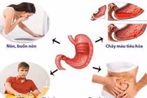 Không dùng men tiêu hóa khi đau dạ dày 
