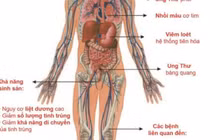 Cơ chế thuốc lá gây u bàng quang