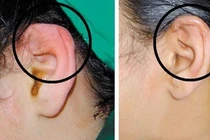 Khuyết tật nghe nói có phẫu thuật được không?