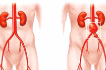 Đặt stent graft điều trị bệnh lý động mạch chủ bụng