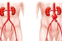 Đặt stent graft điều trị bệnh lý động mạch chủ bụng