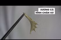 Bác sĩ “choáng” với xương cá hình chân con vịt trong thực quản bệnh nhi