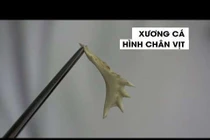 Bác sĩ “choáng” với xương cá hình chân con vịt trong thực quản bệnh nhi