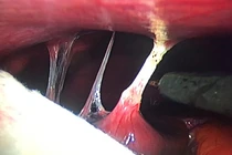 Viêm nhiễm tiểu khung cẩn thận hội chứng FHC viêm bao gan